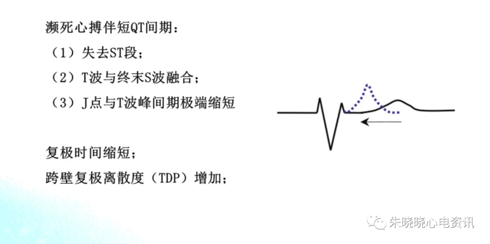 濒死心电图特点