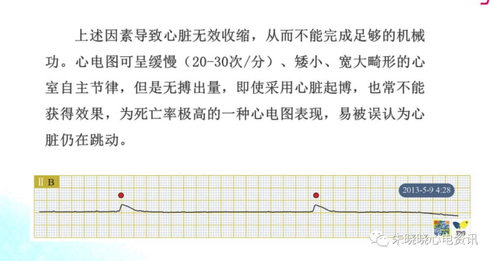 濒死心电图特点