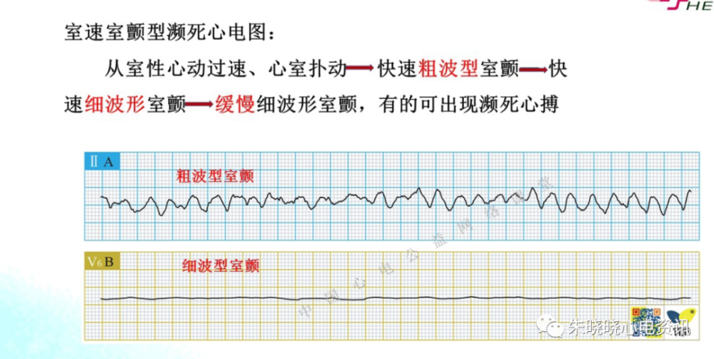 濒死心电图特点