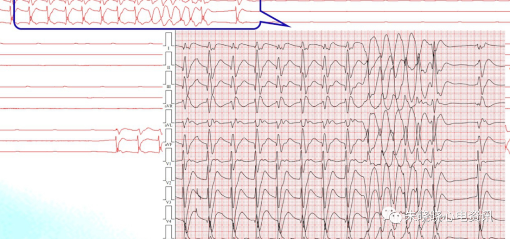 濒死心电图特点