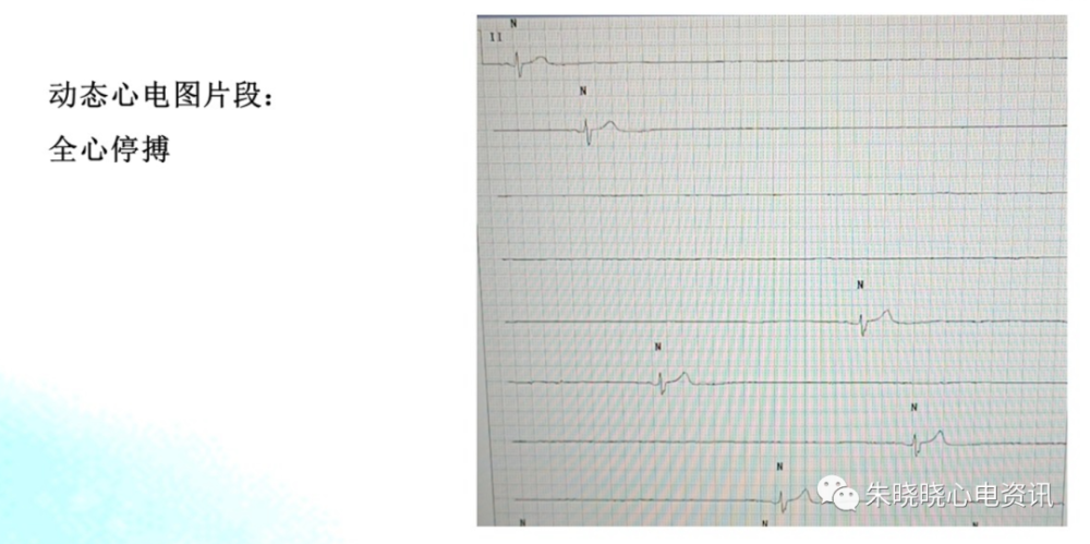 濒死心电图特点