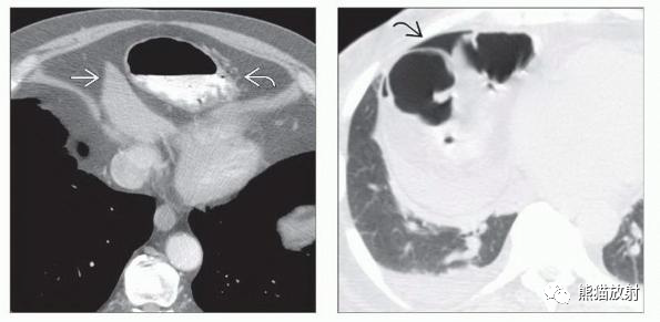 胸部影像诊断图例丨几种膈疝