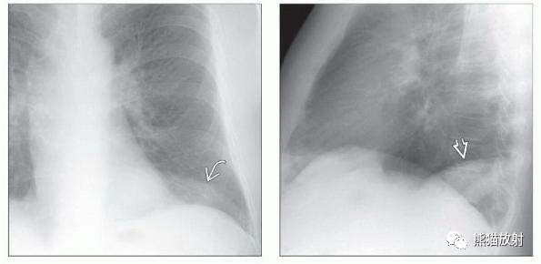 胸部影像诊断图例丨几种膈疝