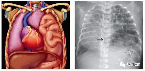 胸部影像诊断图例丨几种膈疝