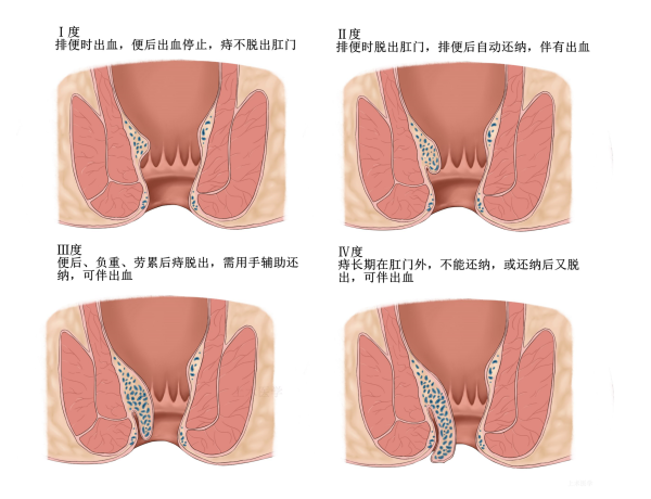 西安东大肛肠医院丨痔疮到底该不该做手术做过的人会后悔吗