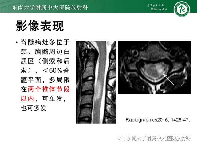 两侧hoffmann征,rossolimo征阳性,两侧巴氏征可疑阳性现病史:患者三年