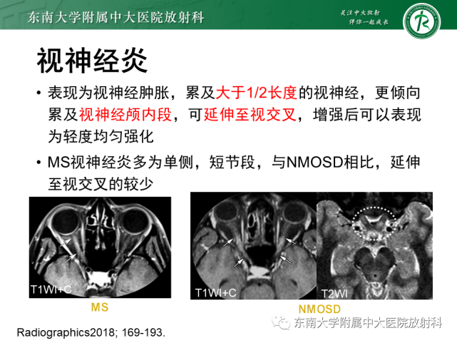 m影像学检查眼球向左轻微水平震颤,两侧hoffmann征,rossolimo征阳性