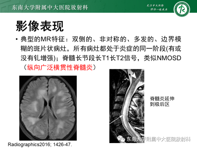 m影像学检查眼球向左轻微水平震颤,两侧hoffmann征,rossolimo征阳性