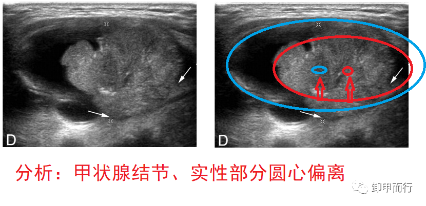 709观察秘诀6囊实性结节的良恶性判断