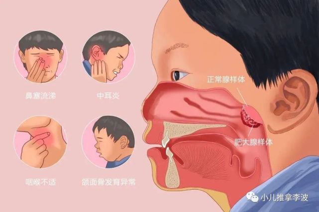 中医儿科李波:孩子腺样体肥大有哪些原因和症状?如何