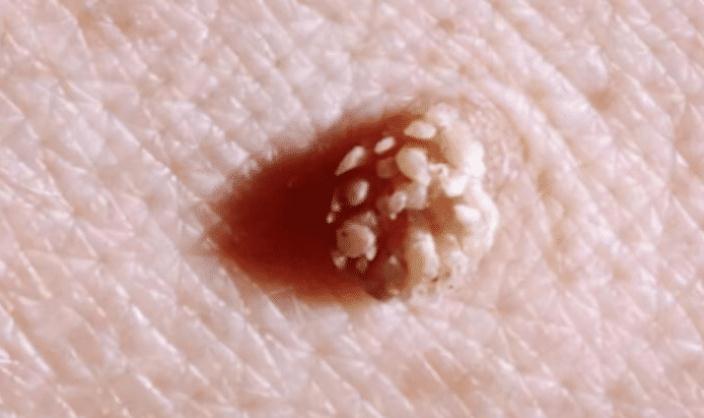 身上3处长有小肉粒的人要尽量远离明眼人一看就知是hpv携带者