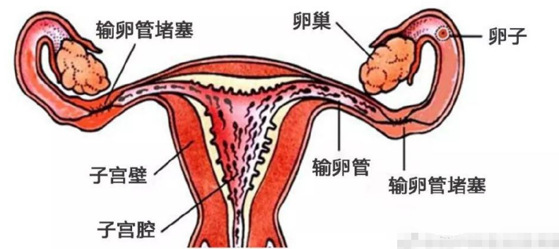 输卵管堵塞该怎么通