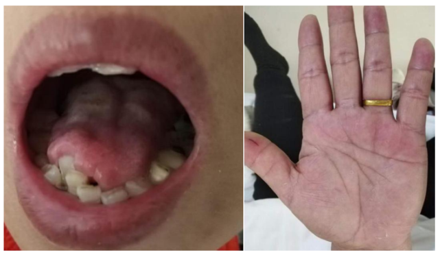 53岁女性,进行性吐词不清,舌肌萎缩6月.