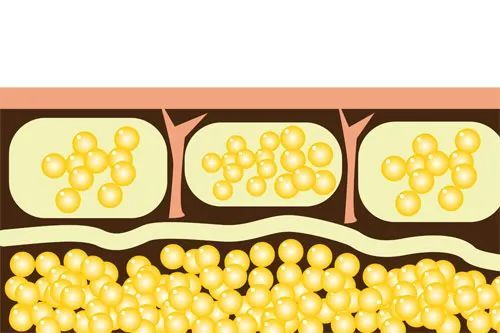 一,颗粒脂肪由于脂肪处理的方法不同,产生了许多新的脂肪组织名称,如