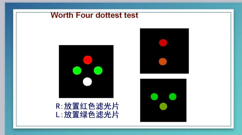 worth四点检查分析原理三级视功能是指两只眼睛具有的本质特性,两只