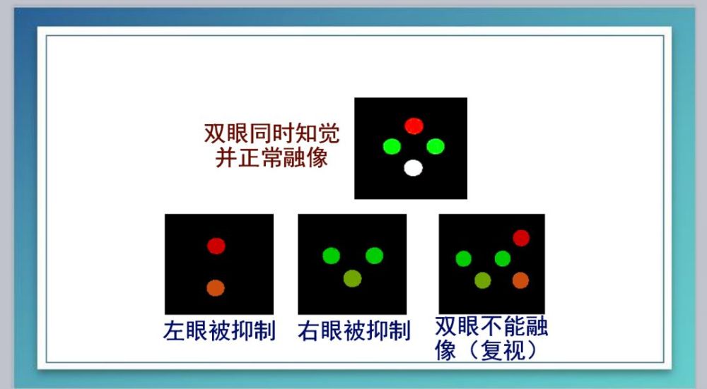 worth四点检查分析原理三级视功能是指两只眼睛具有的本质特性,两只