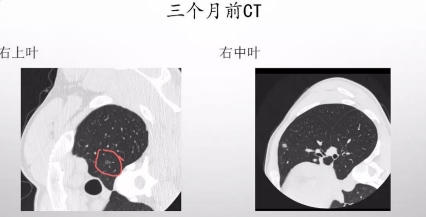 这种肺结节我为何判断它是恶性的肺结节的诊治我有一些经验与你分享