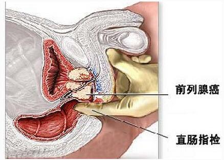 前列腺癌一般有5个症状如果出现3个以上就已经相当严重了