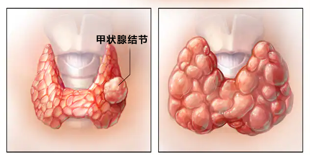 爱生气的女人更容易得甲状腺结节吗