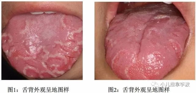 地图舌最早出现在6至12个月的年龄段的宝宝,是5岁以内儿童常见病症,且
