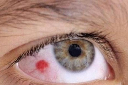 一般来说,睫状充血比较严重,多见于葡萄膜炎和青光眼.