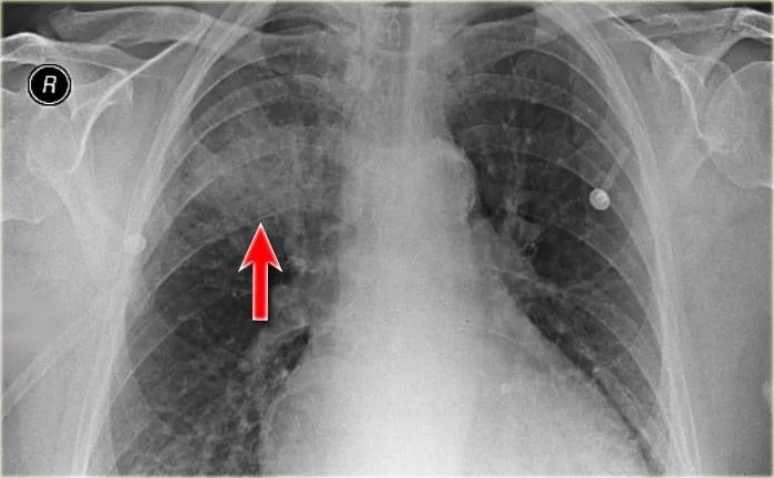 胸部x线肺部病变一实变