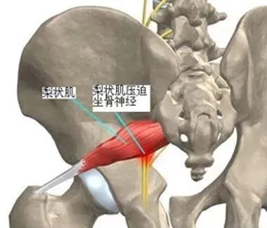 梨状肌卡压神经与腰椎间盘突出压迫的神经疼痛有哪些不同