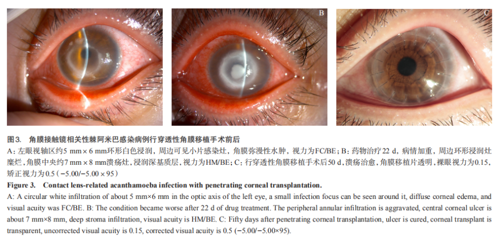 角膜接触镜相关感染性角膜炎20例临床特征