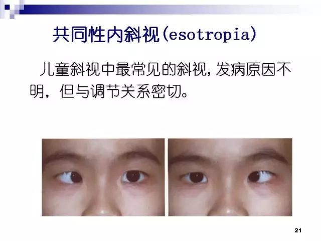 一文看懂斜视与弱视
