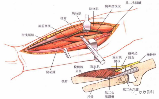 桡神经穿过旋后肌腱弓进入旋后肌.