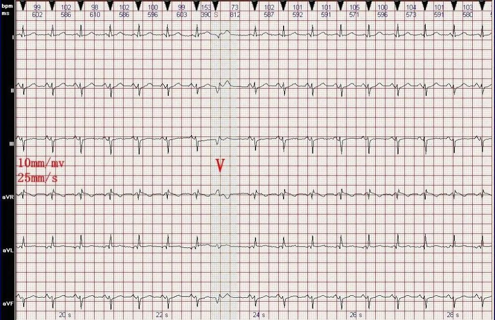 心电图病例分析42前壁肌型室性早搏