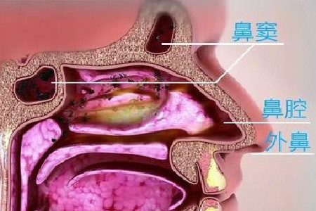 鼻腔鼻窦肿瘤勿存侥幸心理要及时就诊