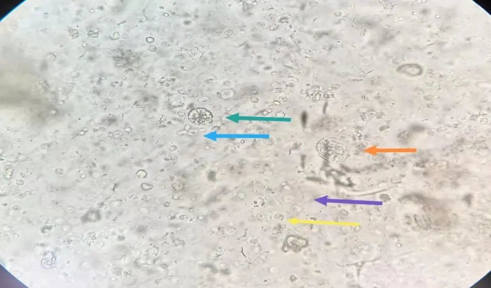 浆膜腔积液形态学案例分析