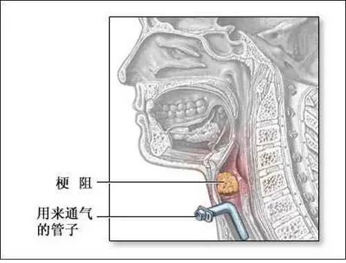 被认为是"割喉"的气管切开并不可怕!后期护理较为重要