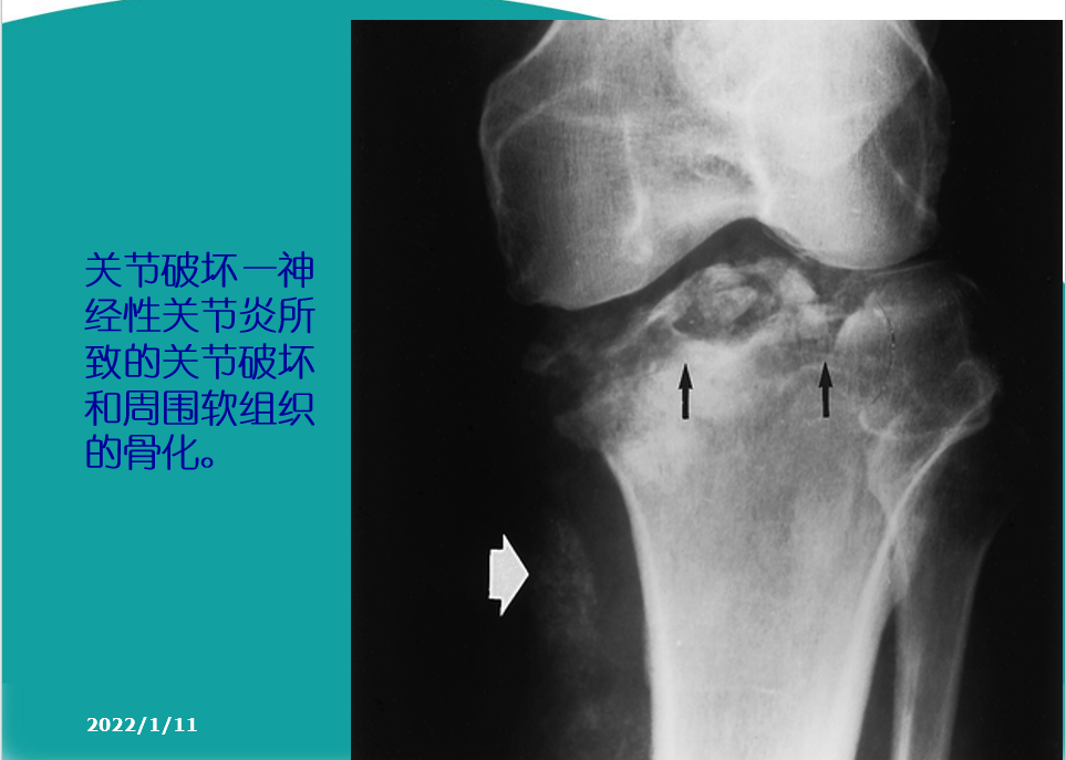 骨科精读肿痛难耐的膝关节骨性关节炎诊治八要点