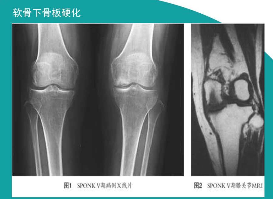 骨科精读肿痛难耐的膝关节骨性关节炎诊治八要点