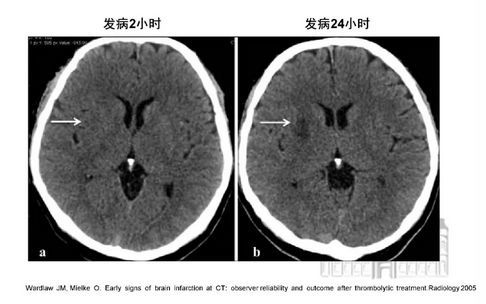 脑梗死急诊大咖教你看透ct片子