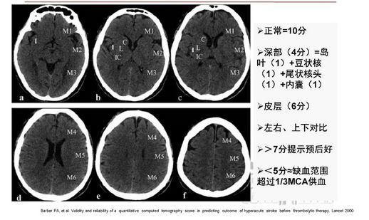 脑梗死急诊大咖教你看透ct片子