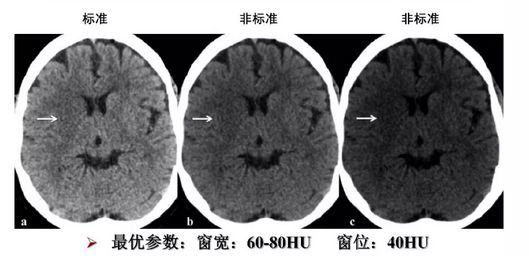 ct平扫(ncct)作为最常规的检查之一,合适窗宽窗位更有利于病灶的显示