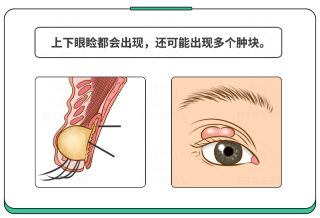 霰粒肿:霰粒肿比较闷,不太引人注意;麦粒肿却是暴脾气,一眼就能认出它