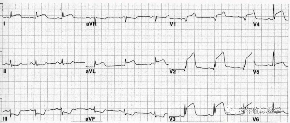 心电图定位诊断下壁心肌梗死:坏死型 q 波出现在,avf 导联右冠状