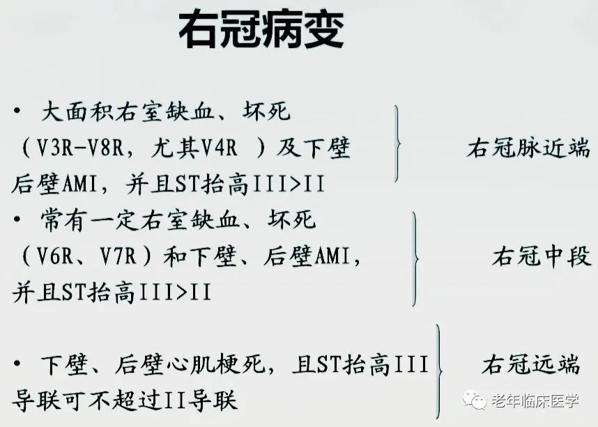 心电图定位诊断下壁心肌梗死:坏死型 q 波出现在,avf 导联右冠状