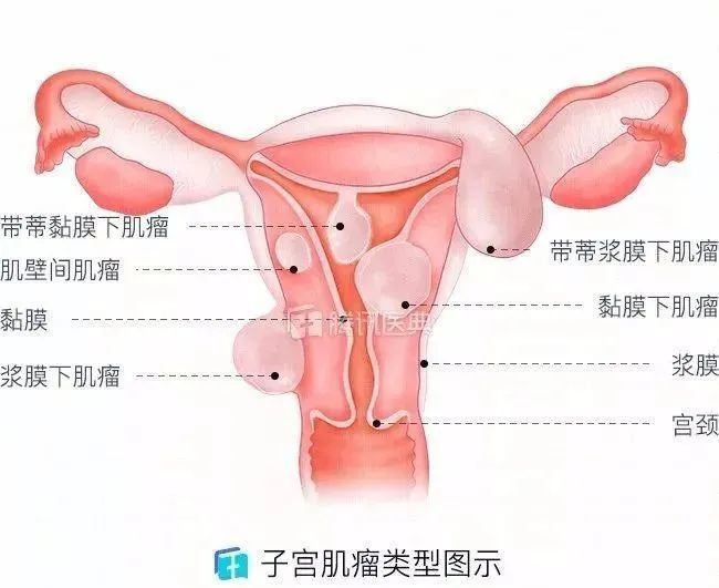 美亚试管不同位置的子宫肌瘤对于女性有哪些影响