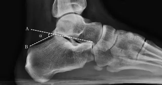 跟骨角变小,提示有扁平足或跟骨骨折;角度增大,提示弓形足距跟后关节