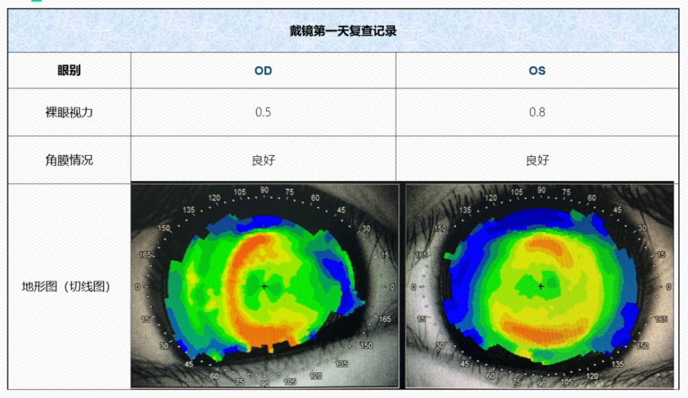 根据角膜地形图,由于患者的角膜形态,左眼和右眼都偏向鼻侧.