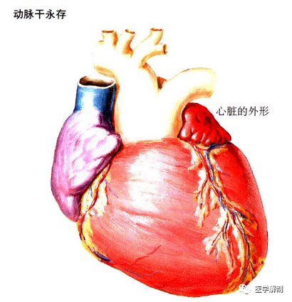 动脉干永存大血管错位法洛四联症(黑体字标注表示4种原发缺陷)升主