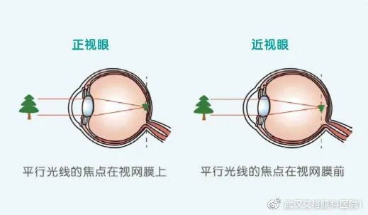 真性近视目前还没有有效的治疗方法,但可以通过配戴合适的框架眼镜或