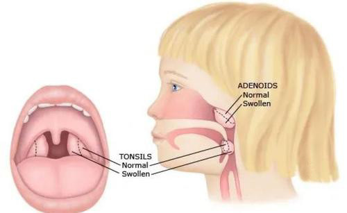 为什么要切腺样体和扁桃体术后有哪些值得注意的