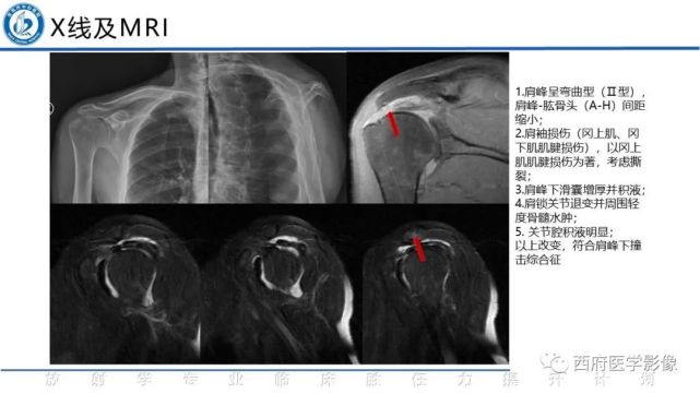 肩峰下撞击综合征影像断与鉴别诊断