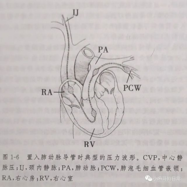 肺动脉导管监测